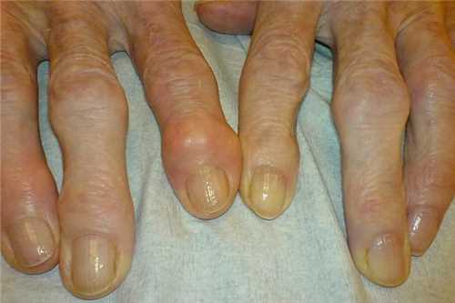 artróza prstových kĺbov